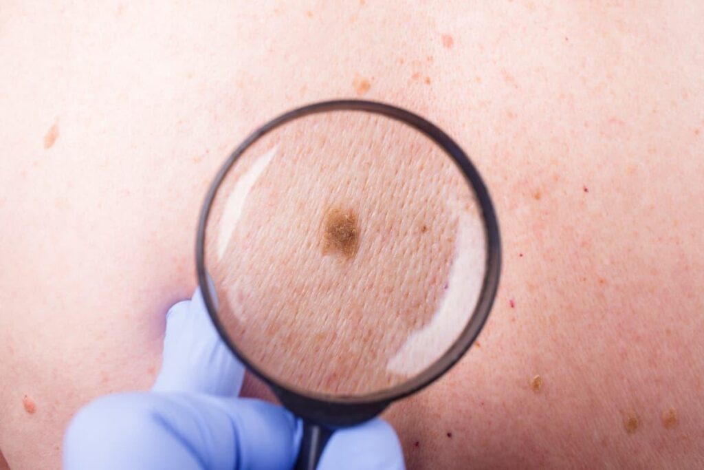 Aumentan los casos de melanoma en la Argentina: quiénes tienen más riesgo y una regla clave para cuidarnos